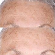 Perricone MD Cold Plasma Plus+ Concentrated Treatment Sheet Mask - Sin...